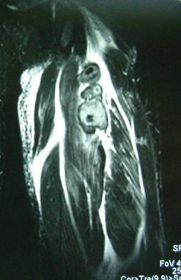 大腿ハムストリング腱断裂MRI画像