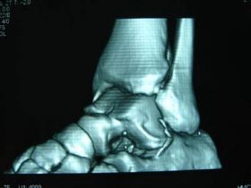 足関節鏡手術後 3D-CT画像